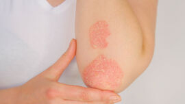 psoriasis_shutterstock_1494344612-(2)