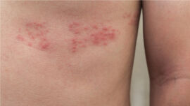 Gürtelrose Herpes zoster - Typisch ist der schmerzende, halbseitige Hautausschlag mit Bläschen, die stark brennen und jucken. - © Shutterstock
